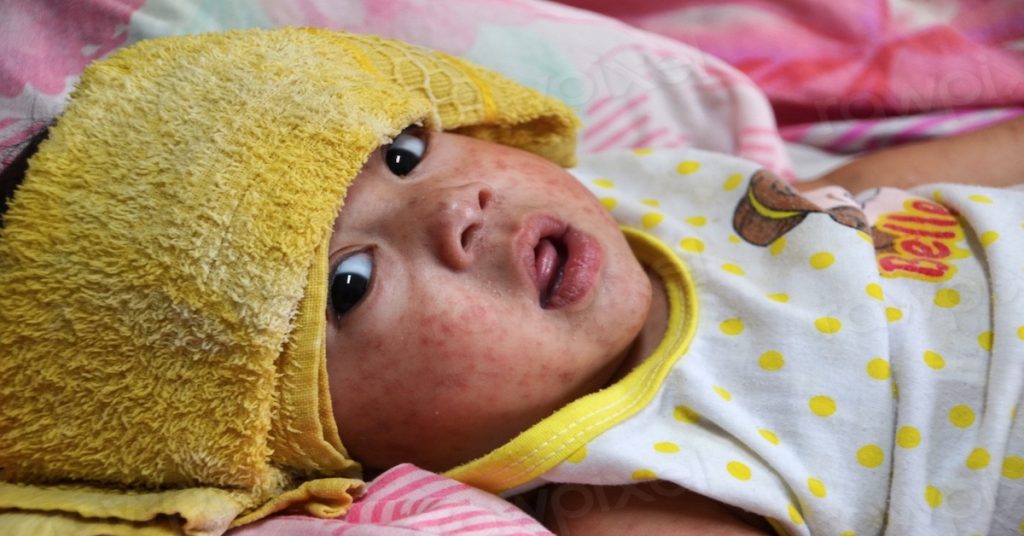 Measles Upper Mt Gravatt